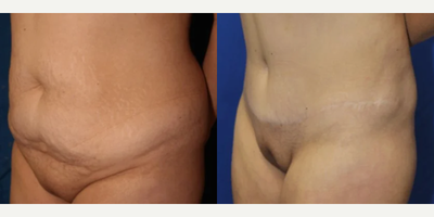 Case 1097 - Woman treated with Tummy Tuck