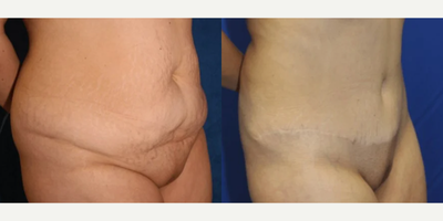 Case 1098 - Woman treated with Tummy Tuck