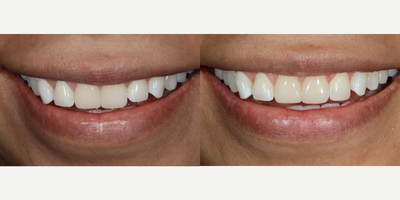 Case 10981 - 25-34 year old woman treated with Dental Bonding