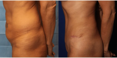 Case 1099 - Woman treated with Tummy Tuck