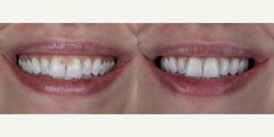 Case 10992 - 25-34 year old woman treated with Dental Bonding