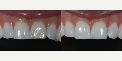 Case 10993 - 35-44 year old woman treated with Dental Bonding