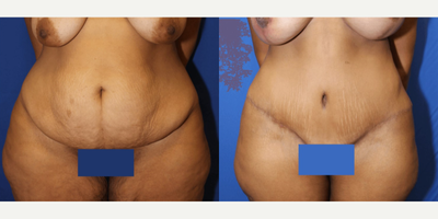 Case 110 - 35-44 year old woman treated with Tummy Tuck