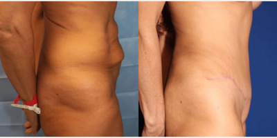 Case 1100 - Woman treated with Tummy Tuck