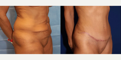 Case 1101 - Woman treated with Tummy Tuck