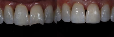 Case 11015 - 45-54 year old woman treated with Dental Bonding