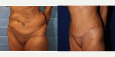 Case 1102 - Woman treated with Tummy Tuck