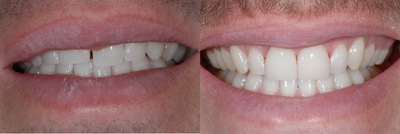 Case 11034 - Dental Bonding to Fix Gap Between Teeth