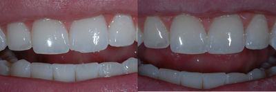 Case 11035 - Dental Bonding for a Small Chip