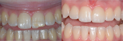 Case 11036 - Dental Bonding using a Porcelain Veneer