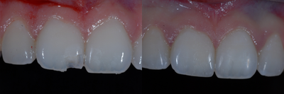 Case 11037 - Dental Bonding to Fix a Chipped Tooth