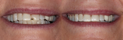 Case 11039 - 65-74 year old woman treated with Dental Bonding