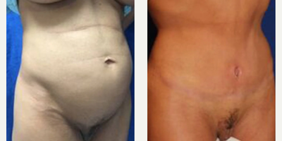 Case 1104 - Woman treated with Tummy Tuck