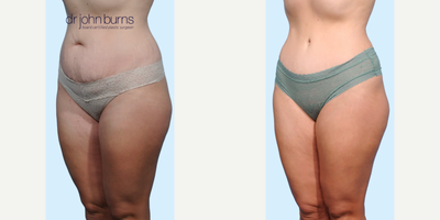 Case 1105 - Woman treated with Tummy Tuck