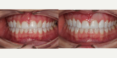 Case 11050 - 25-34 year old woman treated with Dental Bonding