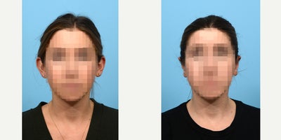 Case: 11051 - before and after photo of 25-34 year old woman treated with Ear Surgery by Jeffrey B. Wise, MD, FACS