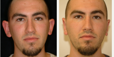Case: 11052 - before and after photo of 25-34 year old man treated with Ear Surgery by Arthur Dean Jabs, MD, PhD, FACS