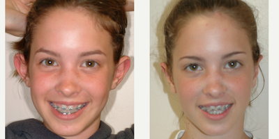 Case: 11053 - before and after photo of 17 or under year old woman treated with Ear Surgery by Arthur Dean Jabs, MD, PhD, FACS