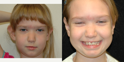 Case: 11054 - before and after photo of 17 or under year old woman treated with Ear Surgery by Arthur Dean Jabs, MD, PhD, FACS