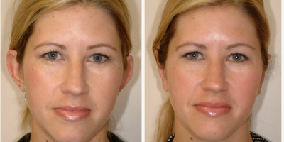 Case: 11055 - before and after photo of 25-34 year old woman treated with Ear Surgery by Arthur Dean Jabs, MD, PhD, FACS