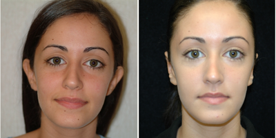 Case: 11056 - before and after photo of 25-34 year old woman treated with Ear Surgery by Arthur Dean Jabs, MD, PhD, FACS