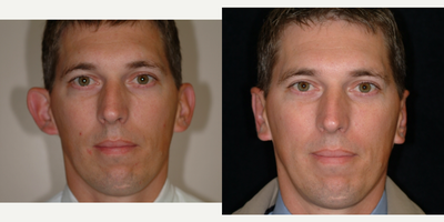 Case: 11057 - before and after photo of 35-44 year old man treated with Ear Surgery by Arthur Dean Jabs, MD, PhD, FACS