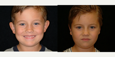 Case: 11058 - before and after photo of 17 or under year old man treated with Ear Surgery by Arthur Dean Jabs, MD, PhD, FACS