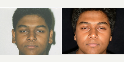 Case: 11059 - before and after photo of 18-24 year old man treated with Ear Surgery by Arthur Dean Jabs, MD, PhD, FACS