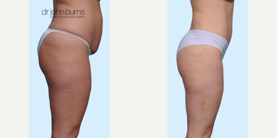 Case 1106 - Woman treated with Tummy Tuck