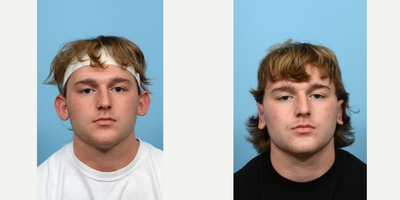 Case 11060 - 18-24 year old man treated with Ear Surgery