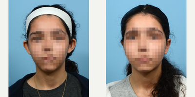 Case 11061 - 17 or under year old woman treated with Ear Surgery