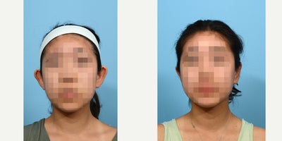 Case 11062 - 18-24 year old woman treated with Ear Surgery