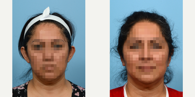 Case 11064 - 45-54 year old woman treated with Ear Surgery