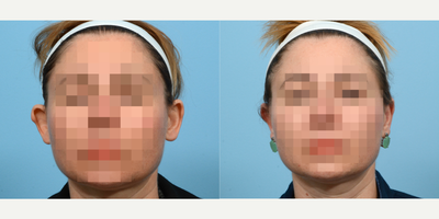 Case 11065 - 45-54 year old woman treated with Ear Surgery