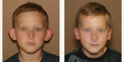 Case 11066 - 6 years old man treated with Ear Surgery