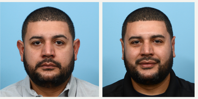 Case 11067 - 35-44 year old man treated with Ear Surgery