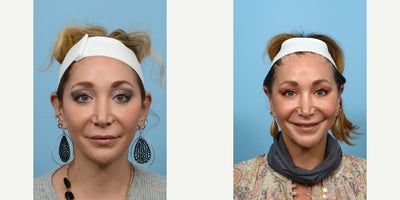 Case 11068 - 35-44 year old woman treated with Ear Surgery