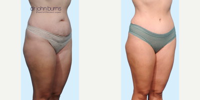 Case 1107 - Woman treated with Tummy Tuck