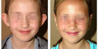 Case 11070 - Woman treated with Ear Surgery