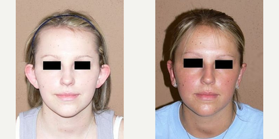 Case 11071 - Woman treated with Ear Surgery