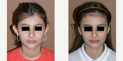 Case 11072 - Woman treated with Ear Surgery