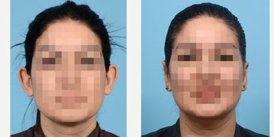 Case 11073 - 35-44 year old woman treated with Ear Surgery