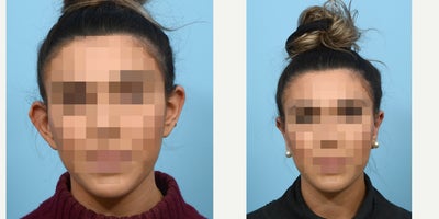 Case 11074 - 18-24 year old woman treated with Ear Surgery