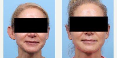 Case 11075 - 45-54 year old woman treated with Ear Surgery