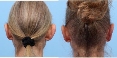 Case 11076 - 45-54 year old woman treated with Ear Surgery