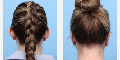 Case 11077 - 35-44 year old woman treated with Ear Surgery