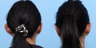 Case 11078 - 25-34 year old woman treated with Ear Surgery