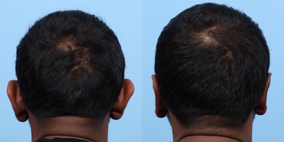 Case 11079 - 35-44 year old man treated with Ear Surgery