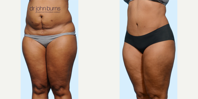 Case 1108 - Woman treated with Tummy Tuck