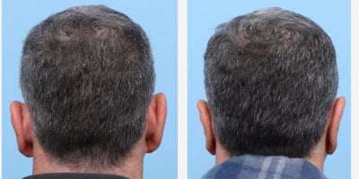 Case 11080 - 55-64 year old woman treated with Ear Surgery